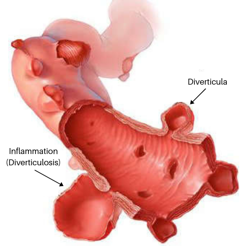 An illustration of Diverticulosis and Diverticula