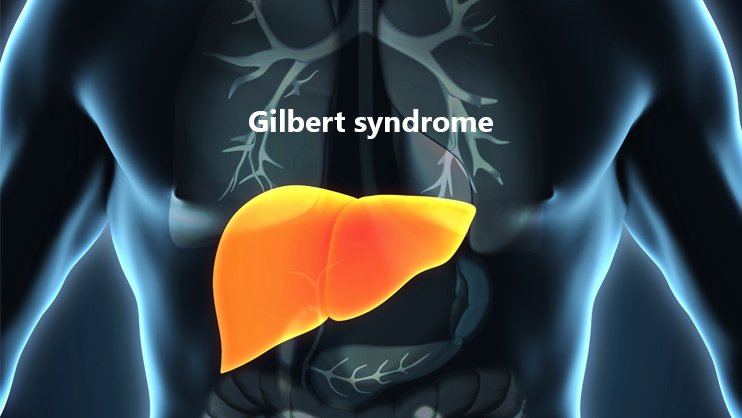 An illustration of Gilbert syndrome