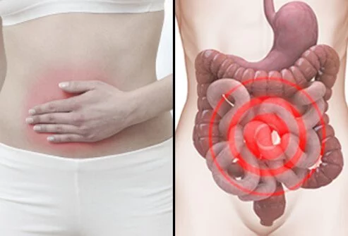 Picture of a lady experiencing symptoms of Duodenal Ulcer/stomach ulcer