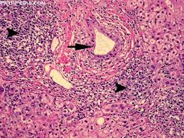 A picture of Autoimmune Hepatitis under microscope