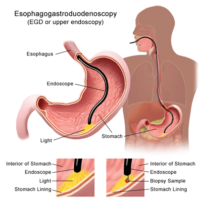 An illustration of Esophagogastroduodenoscopy, a means of detection of the Duodenal Ulcer/stomach ulcer