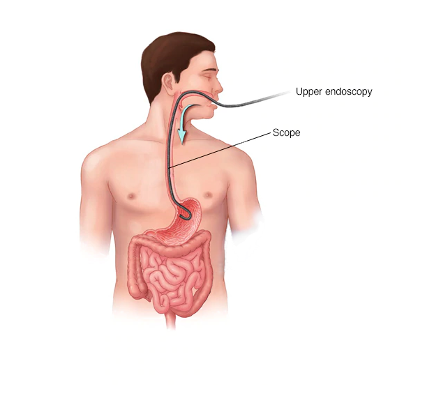 An illustration of an upper Enteroscopy
